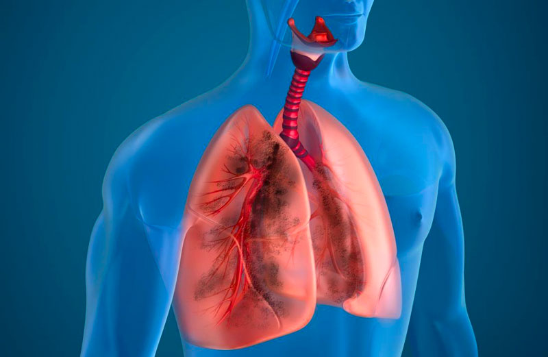 Bệnh phổi tắc nghẽn mạn tính khởi phát do luồng khí bị tắc nghẽn từ phổi gây nên
